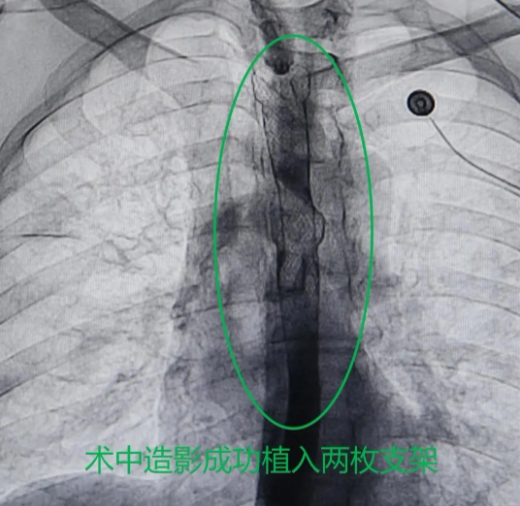 食管支架植入术——破解食管肿瘤患者“吃饭”难题！(图2)