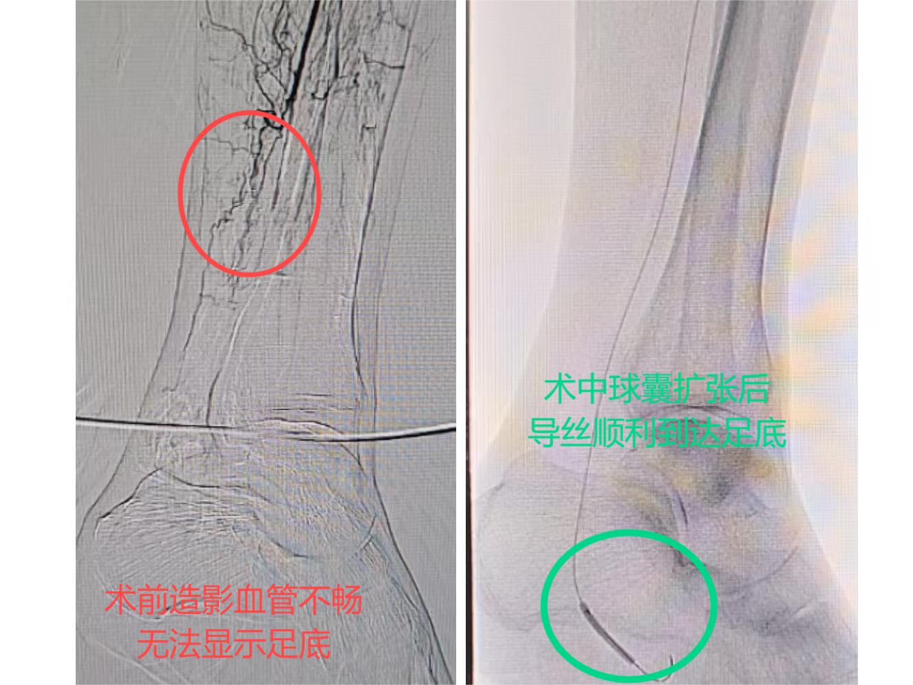 85岁老太左腿突发疼痛，我院周围血管外科团队成功施救，保住患者下肢！(图2)