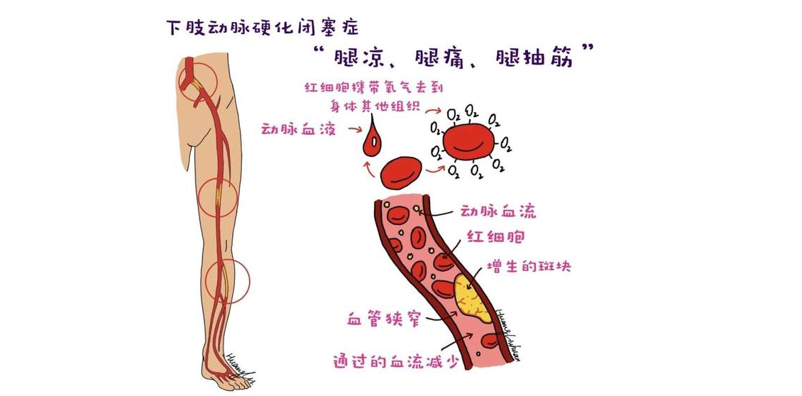 夏日炎炎,还是感觉小腿发凉、脚麻?小心下肢动脉硬化闭塞症!(图1) 夏日炎炎,还是感觉小腿发凉、脚麻?小心下肢动脉硬化闭塞症!(图1)