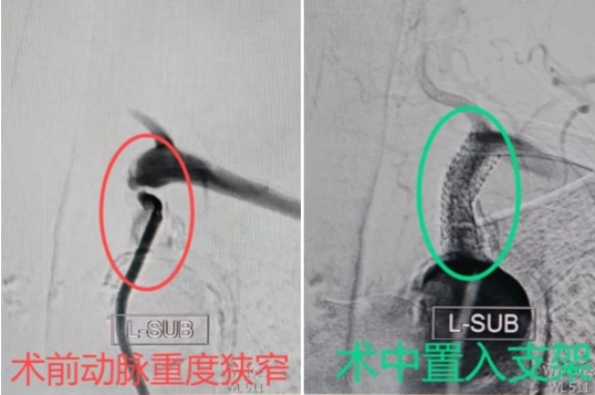 卒中中心团队通力协作，为患者畅通大脑“生命线”(图3)