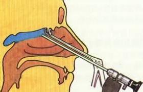 康盈技术 | 功能性鼻窦内窥镜手术，让呼吸更自由！(图2)