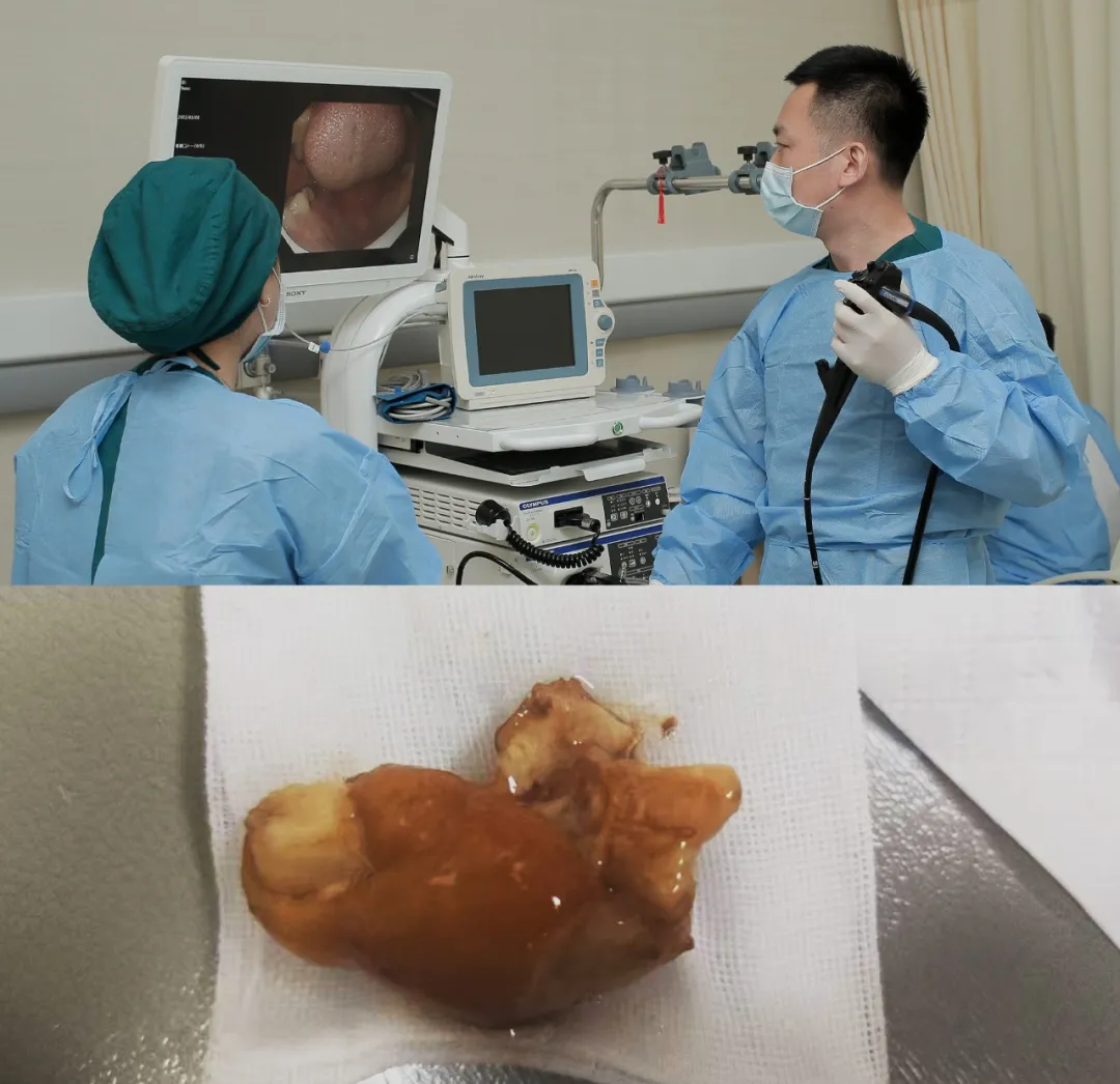 康盈技术 | 八旬老人食道堵塞,消化内科成功施救(图2) 康盈技术 | 八旬老人食道堵塞,消化内科成功施救(图2)